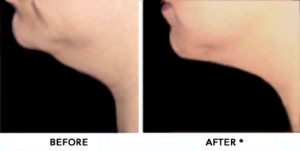 Double Chin Before & After Image | rejuvenation center