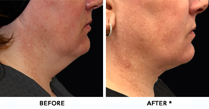 Double Chin Before & After Image | rejuvenation center