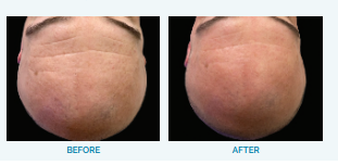 Hydrafacial Before & After Image | Rejuvenation Center | Wheeling, WV