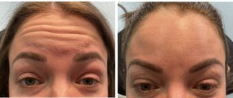Botox Before & After Image | Rejuvenation Center