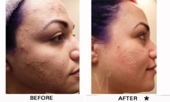 Chemical Peels Before & After Image | Rejuvenation Center