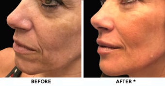 Dermal Fillers Before & After Image | Rejuvenation Center
