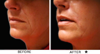 Dermal Fillers Before & After Image | Rejuvenation Center