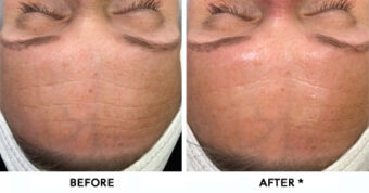 Hydrafacial MD Before & After Image | rejuvenation center