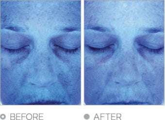 Hydrafacial MD Before & After Image | rejuvenation center