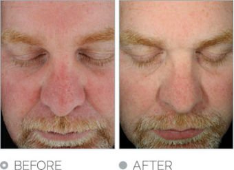 Hydrafacial MD Before & After Image | Rejuvenation Center
