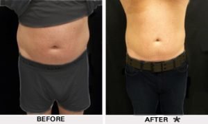 Male Abdomen Before & After Image | Rejuvenation Center