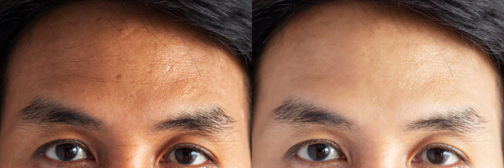 Botox Before & After Image | Rejuvenation Center | Wheeling, WV