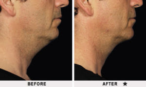 Double Chin Treatment Before & After Image | Rejuvenation Center