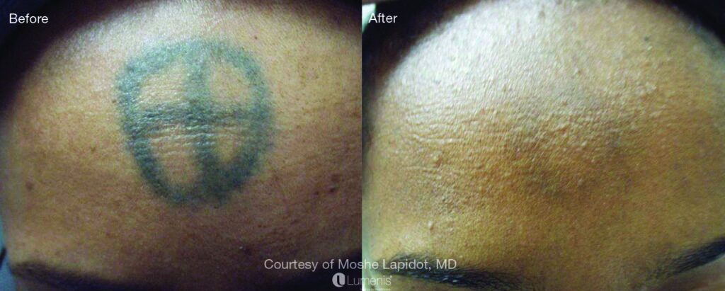 Tattoo Removal Before & After Image | Rejuvenation Center