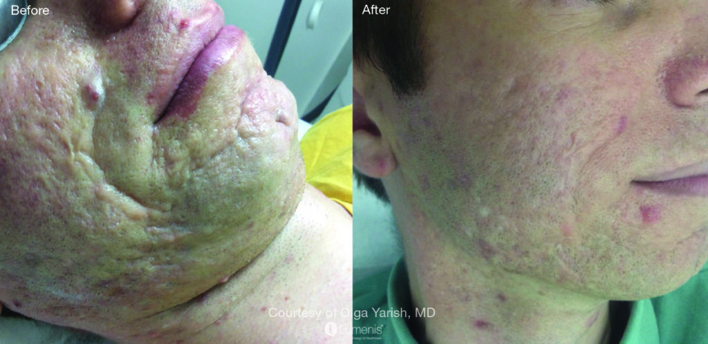 Textural Treatment acne2