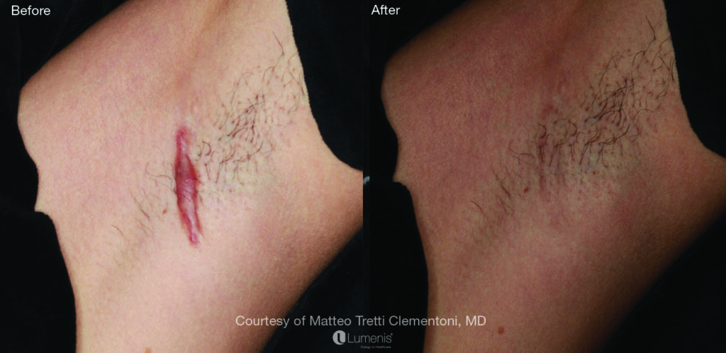 Textural Treatment scar