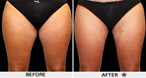 thigh liposuction b a rejuvenationcenter