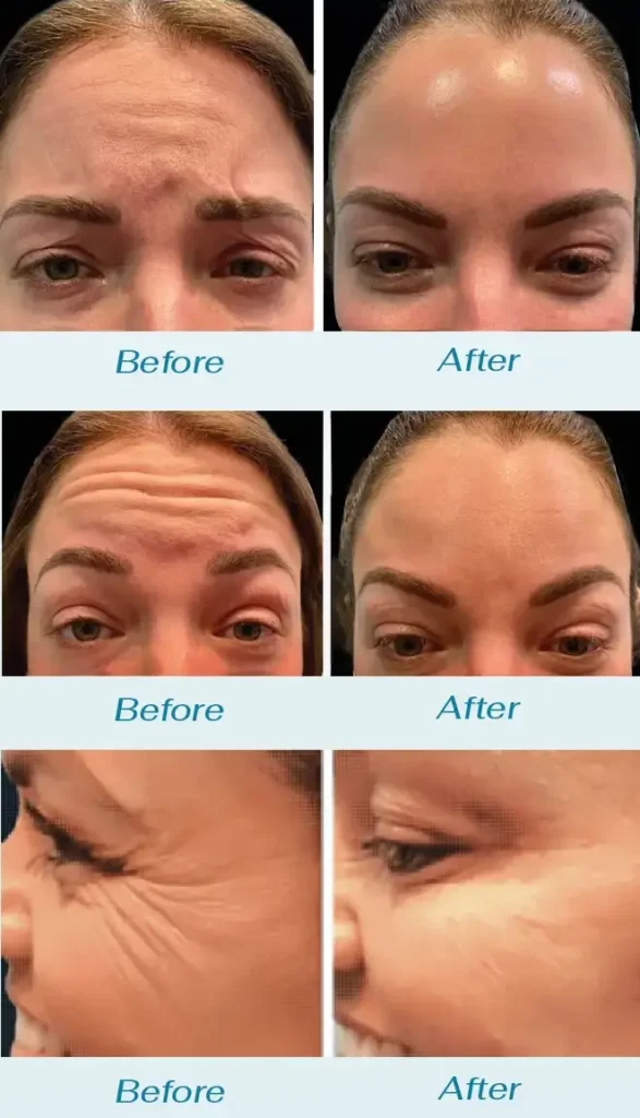Bridal Packages 3 Bridal botox ba