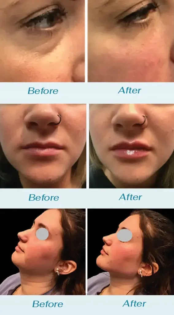 Bridal Packages 5 Bridal dermal filler ba