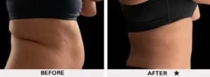 Safesculpt BA a