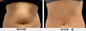 Safesculpt BA c