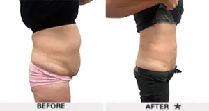rejuvenation sculpt 2 1