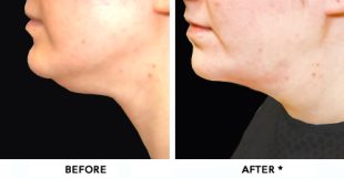 Double Chin Before & After Image | rejuvenation center