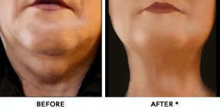 Double Chin Before & After Image | rejuvenation center