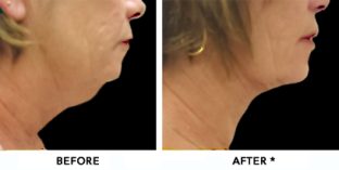 Double Chin Before & After Image | rejuvenation center