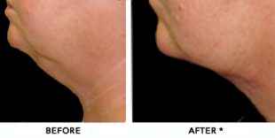 Double Chin Before & After Image | rejuvenation center