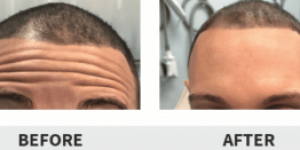 Botox Before & After Image | Rejuvenation Center