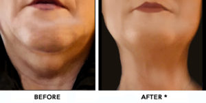 Double Chin Before & After Image | rejuvenation center