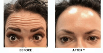 Botox® Dysport® Xeomin® Jeuveau® 8 Botox Before & After Image | Rejuvenation Center