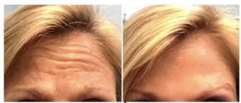 Botox® Dysport® Xeomin® Jeuveau® 10 Botox Before & After Image | Rejuvenation Center