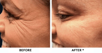 Botox® Dysport® Xeomin® Jeuveau® 11 Botox Before & After Image | Rejuvenation Center