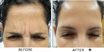 Botox® Dysport® Xeomin® Jeuveau® 3 Botox Before & After Image | Rejuvenation Center