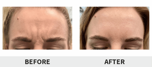 Botox® Dysport® Xeomin® Jeuveau® 13 Botox Before & After Image | Rejuvenation Center