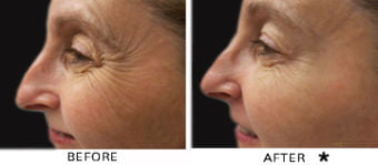 Botox® Dysport® Xeomin® Jeuveau® 5 Botox Before & After Image | Rejuvenation Center