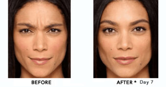 Botox® Dysport® Xeomin® Jeuveau® 7 Botox Before & After Image | Rejuvenation Center