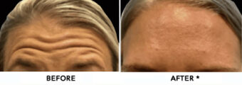 Botox® Dysport® Xeomin® Jeuveau® 14 Botox Before & After Image | Rejuvenation Center