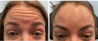 Botox® Dysport® Xeomin® Jeuveau® 9 Botox Before & After Image | Rejuvenation Center