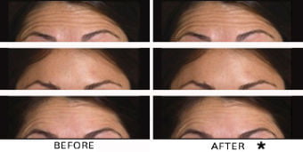 Botox® Dysport® Xeomin® Jeuveau® 4 Botox Before & After Image | Rejuvenation Center