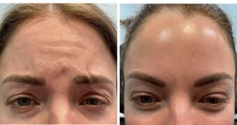 Botox® Dysport® Xeomin® Jeuveau® 12 Botox Before & After Image | Rejuvenation Center