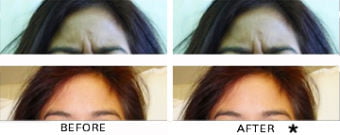 Botox® Dysport® Xeomin® Jeuveau® 6 Botox Before & After Image | Rejuvenation Center