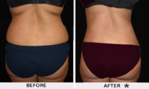 Safe Sculpt Before & After Image | Rejuvenation Center