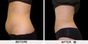 Safe Sculpt Before & After Image | Rejuvenation Center