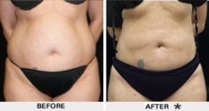 Safe Sculpt Before & After Image | Rejuvenation Center