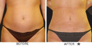 Safe Sculpt Before & After Image | Rejuvenation Center