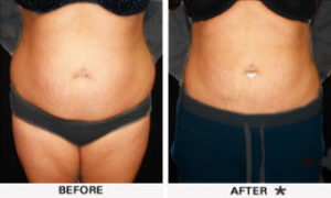Safe Sculpt Before & After Image | Rejuvenation Center