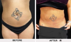 Safe Sculpt Before & After Image | Rejuvenation Center