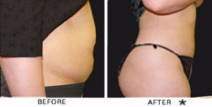 Safe Sculpt Before & After Image | Rejuvenation Center