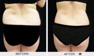 Safe Sculpt Before & After Image | Rejuvenation Center