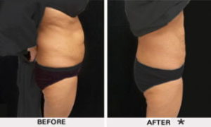 Safe Sculpt Before & After Image | Rejuvenation Center