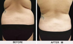 Safe Sculpt Before & After Image | Rejuvenation Center